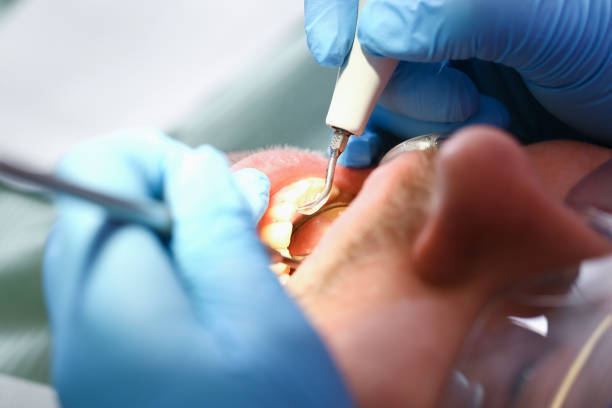 Best Emergency Wisdom Teeth Removal in Valrico, FL