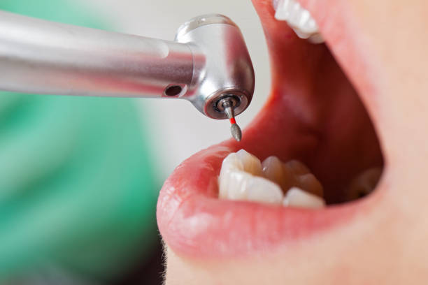 Best Emergency Treatment for Dental Infections or Abscesses in Valrico, FL